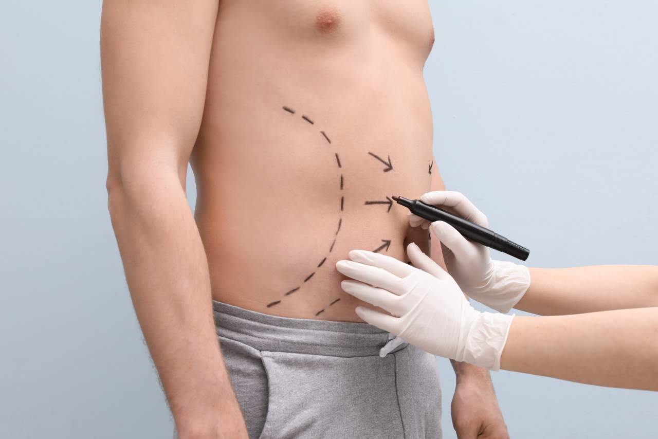 Tratamiento estrella en 2021: eliminar la grasa localizada gracias a la mesoterapia corporal