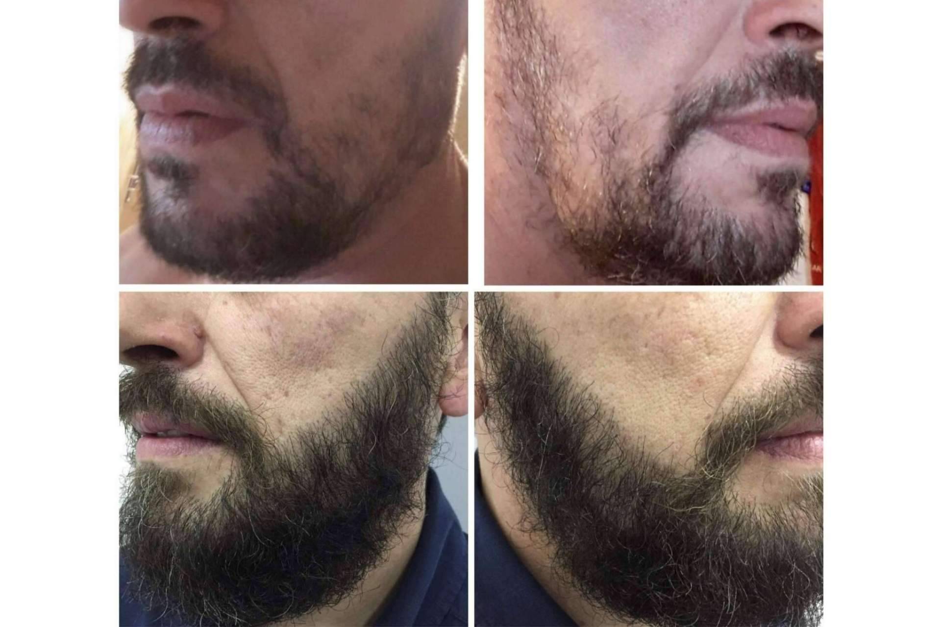 Dr. Bruno Jacobovski, los pasos a seguir en un injerto de barba